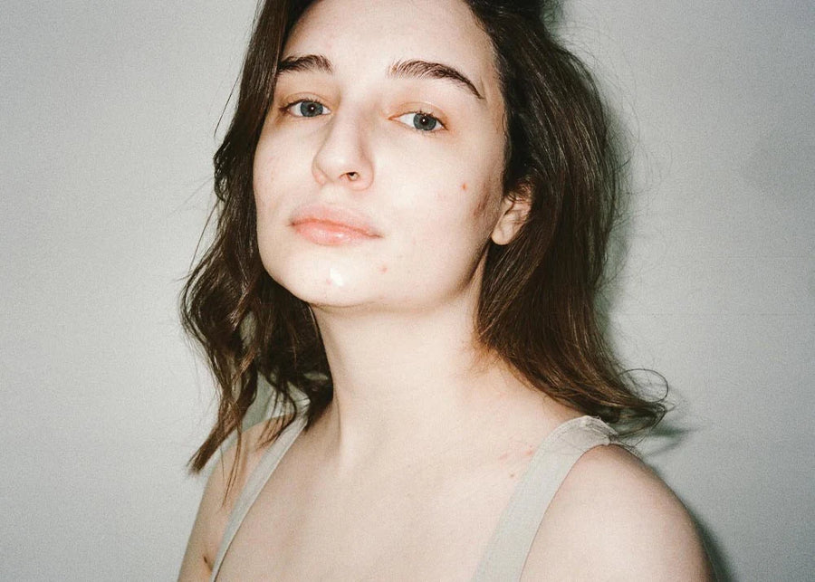 Acne/ Acne Scar