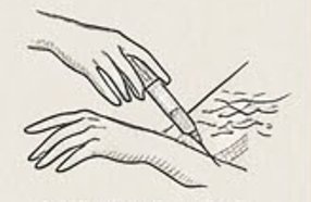 Kenalog Acne Injections