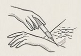 Kenalog Acne Injections